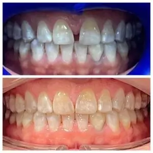 crystal-dent-crystal-dental