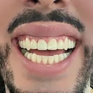 restore-dental-restoration-dentist-los-angeles