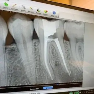 endodontist-los-angeles